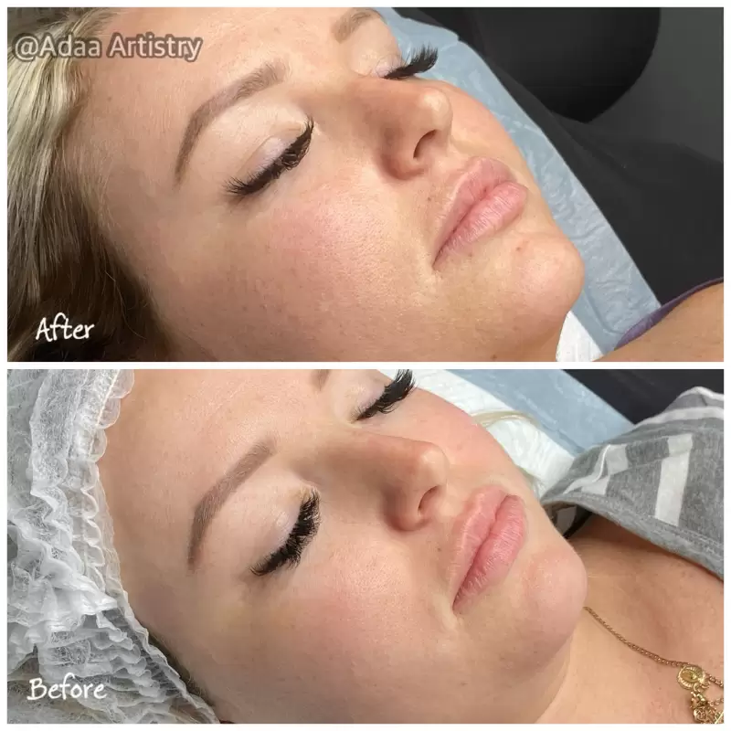 Dermaplane facial smooth glowing skin treatment