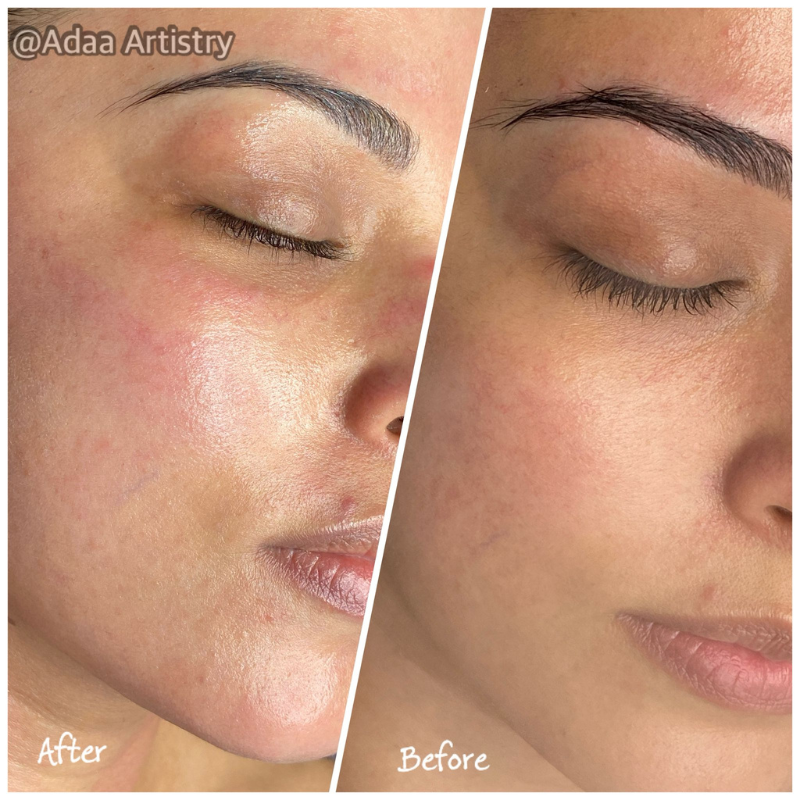 Microneedling collagen induction skin rejuvenation treatment