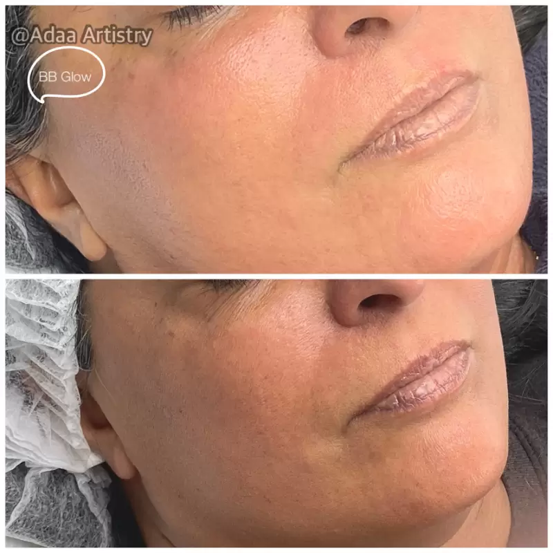 Nano BB glow radiant even skin tone treatment