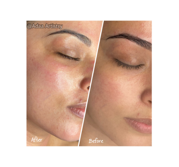Microneedling collagen induction skin rejuvenation treatment