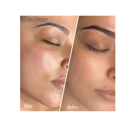 Microneedling collagen induction skin rejuvenation treatment