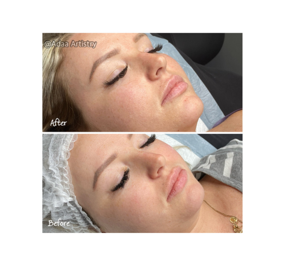 Dermaplane facial smooth glowing skin treatment