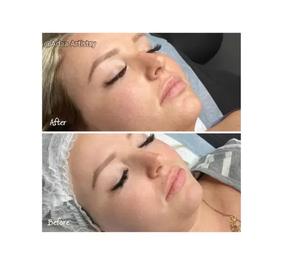 Dermaplane facial smooth glowing skin treatment