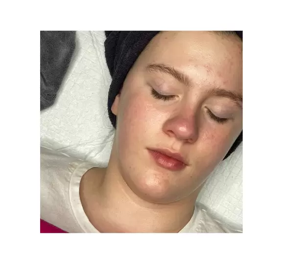 Teen facial gentle skincare clean healthy skin
